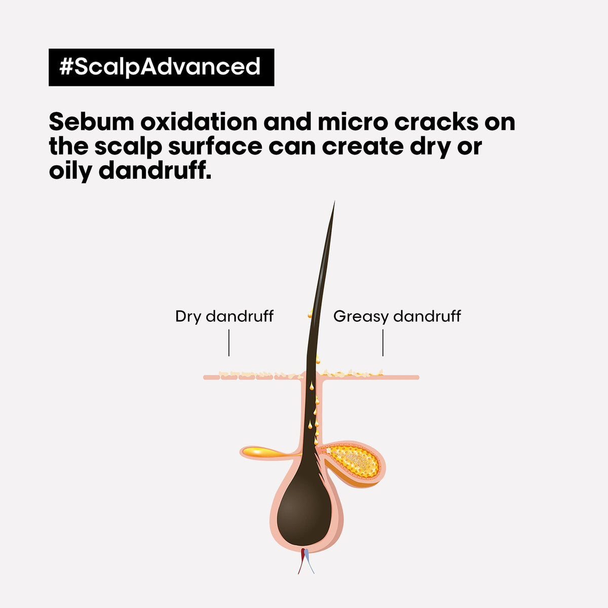 L’Oréal Professionnel SCALP ADVANCED Anti-Oiliness 2-in-1 Clay: Herstellerdarstellung trockener und fettiger Schuppen